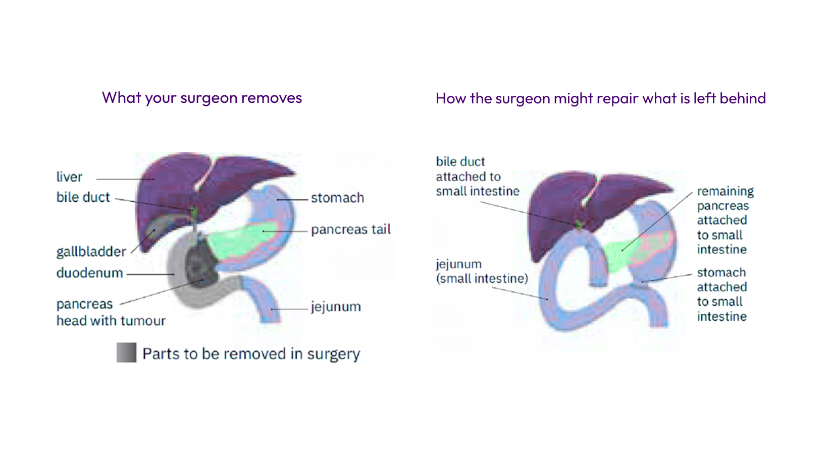 Whipple procedure - organs removed by the surgeon
