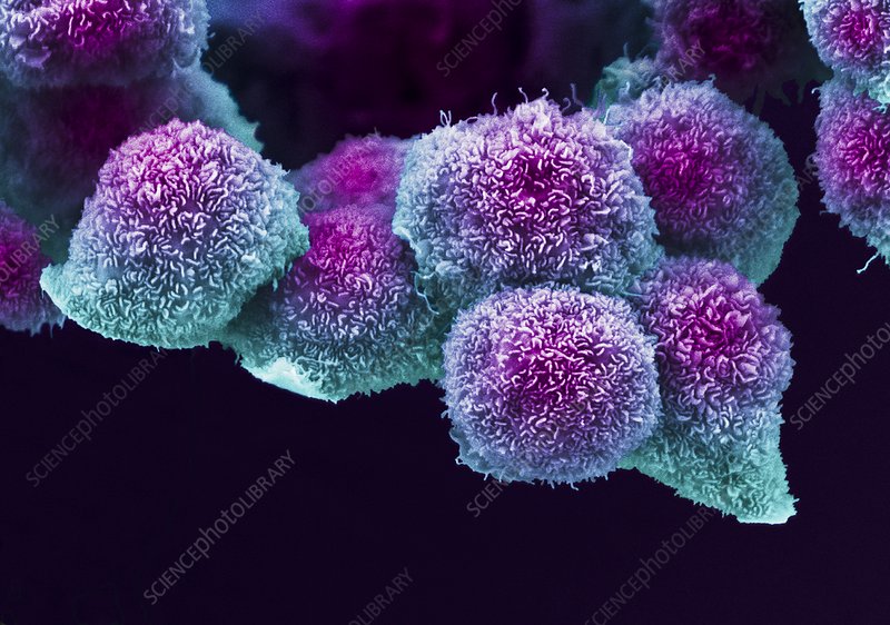 C0460869 Pancreatic Cancer Cell, SEM